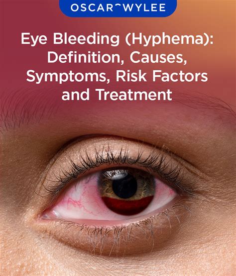 Eye Bleeding Symptoms, Causes, and Treatment